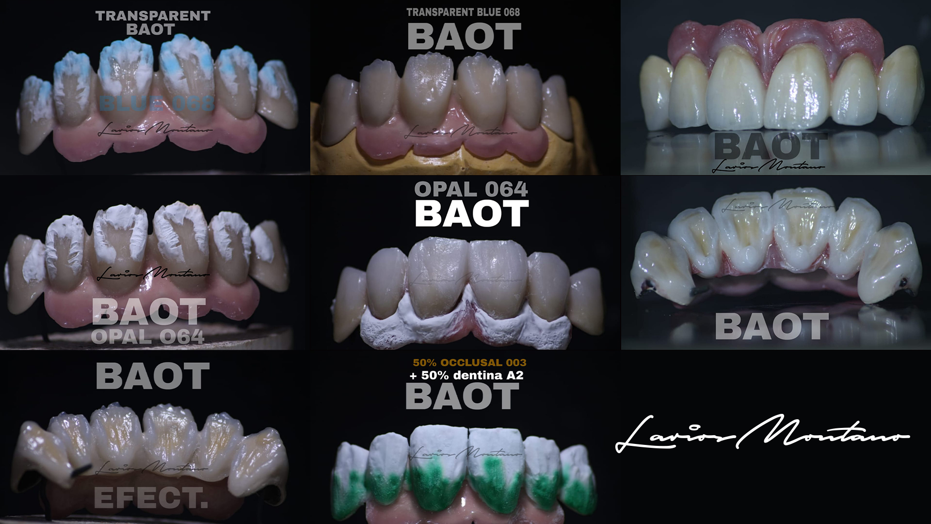 PFM pontic dental ceramic opal effect