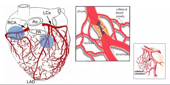 mejorado contrapulsacion externa para el tratamiento de la insuficiencia cardiaca