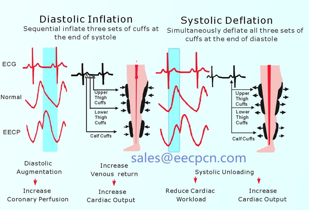 ECP machine Outpatient treatment for heart failure from EECPS Manufacturer