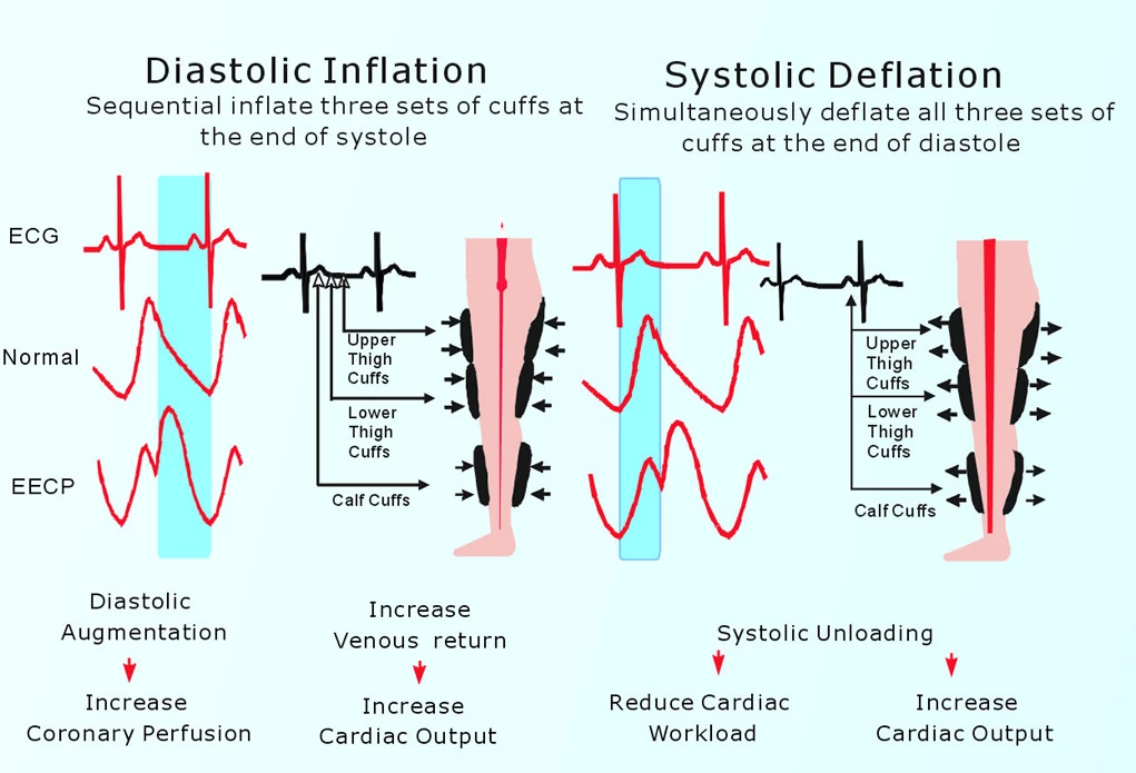 mejorado contrapulsacion externa para el tratamiento de la insuficiencia cardiaca